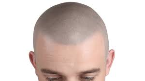 Scalp Micropigmentation