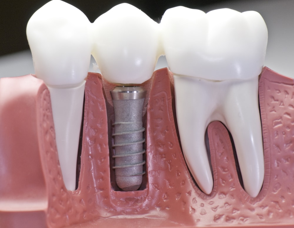 Things to Expect From Experts in Dental Implants